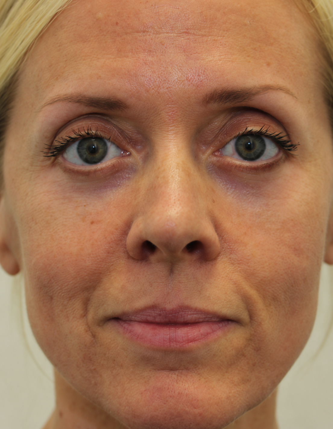 Under-eye with Nuvala Halo