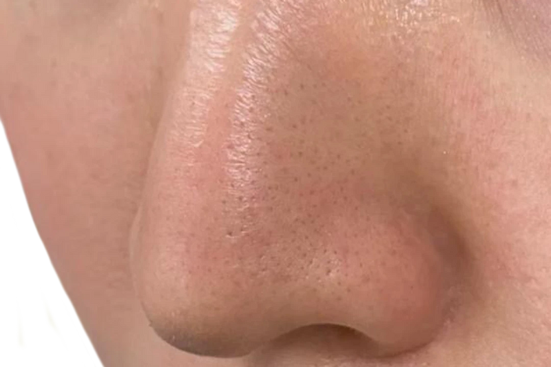Nose and T-zone after