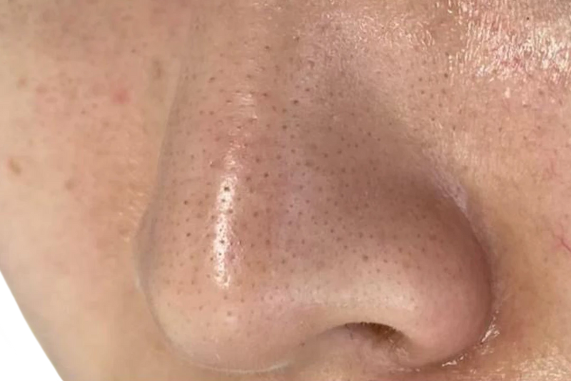 Nose and T-zone before