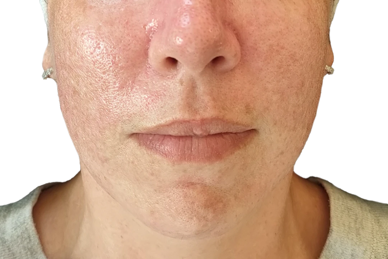 Cheeks and chin after
