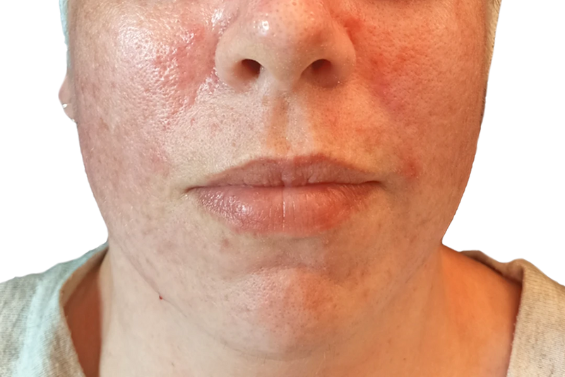 Cheeks and chin before