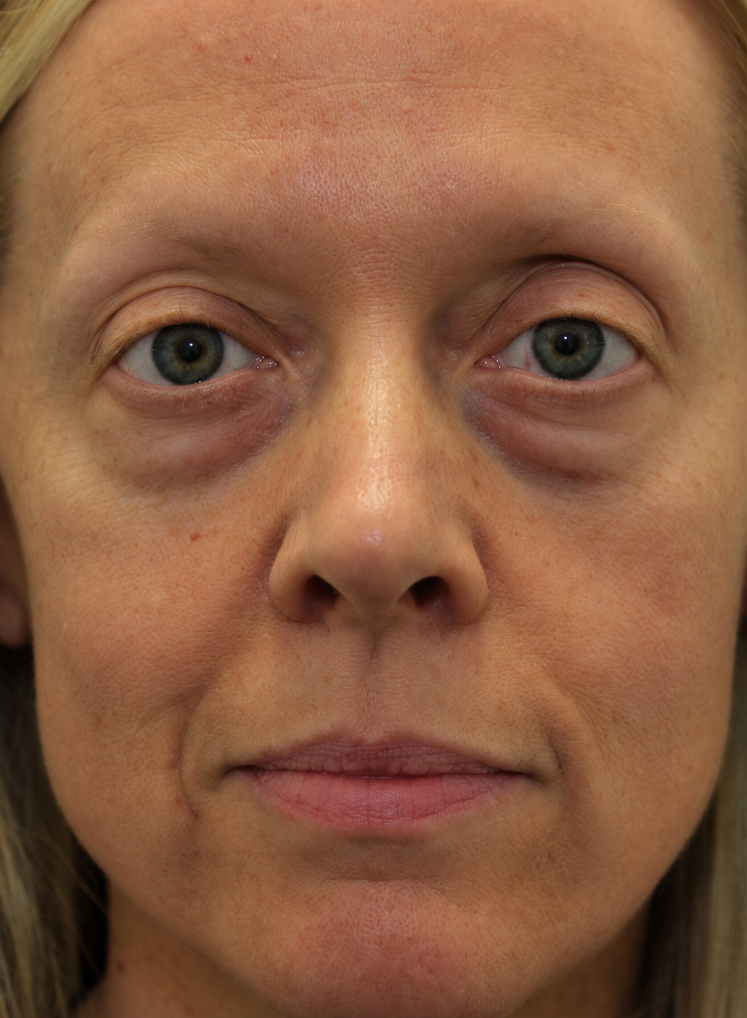 Under-eye without Nuvala Halo